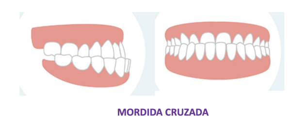Mordida Cruzada